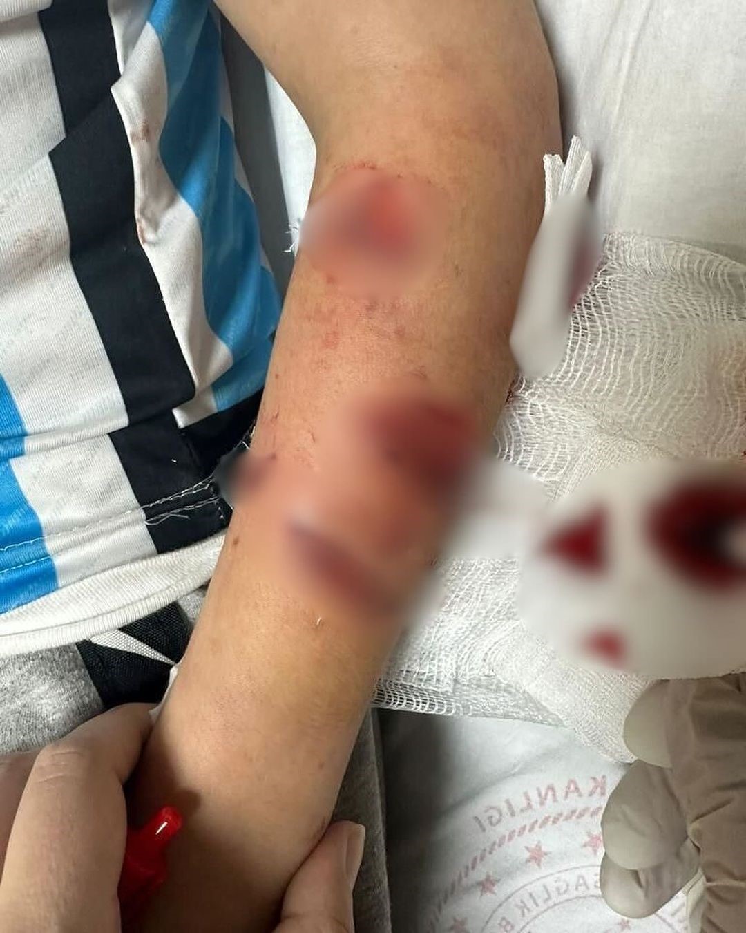 Sevdiği köpeğin saldırısına uğrayan 12 yaşındaki çocuk konuştu: “Köpekle oyun oynarken direkt kollarıma saldırdı”