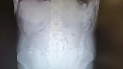 Midesinde uyuşturucu maddeyle yakalanan şahsa 12 yıl hapis cezası!