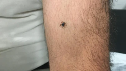 Kayseri’nin bir ilçesinde daha kene vakası!
