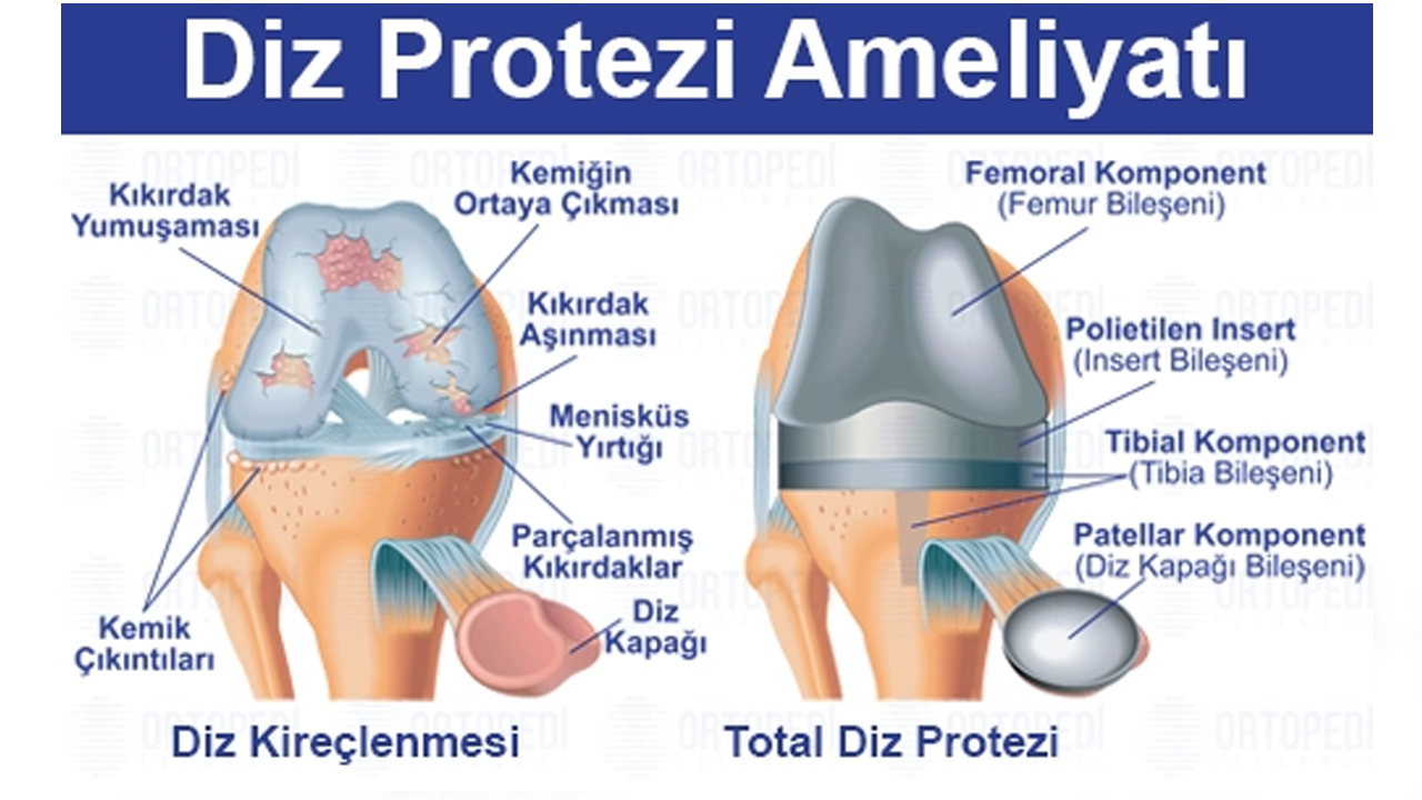 Diz Protezi Ameliyatı: Bilmeniz Gereken Her Şey