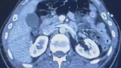 Ülkeye midelerinde uyuşturucu getiren şahıslar yakalandı!