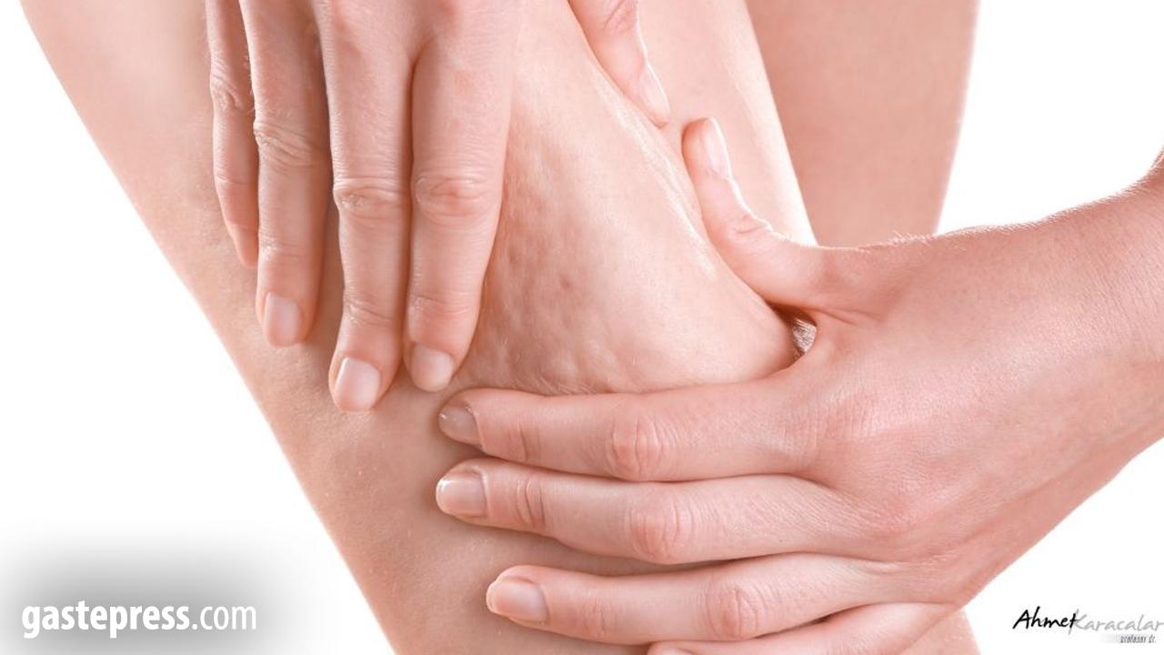 Selülit, Sadece Selülit değildir; Metabolik bir aynadır!