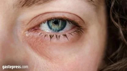 Gözde kaşıntıya dikkat! Bu hastalığın belirtisi olabilir...