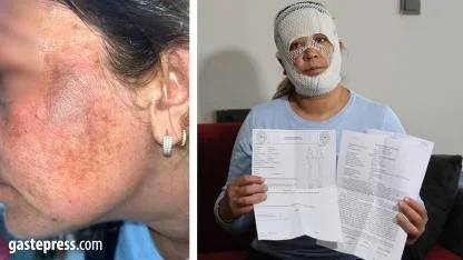 Güzelleşmek uğruna gittiği merkezde yüzü yandı!